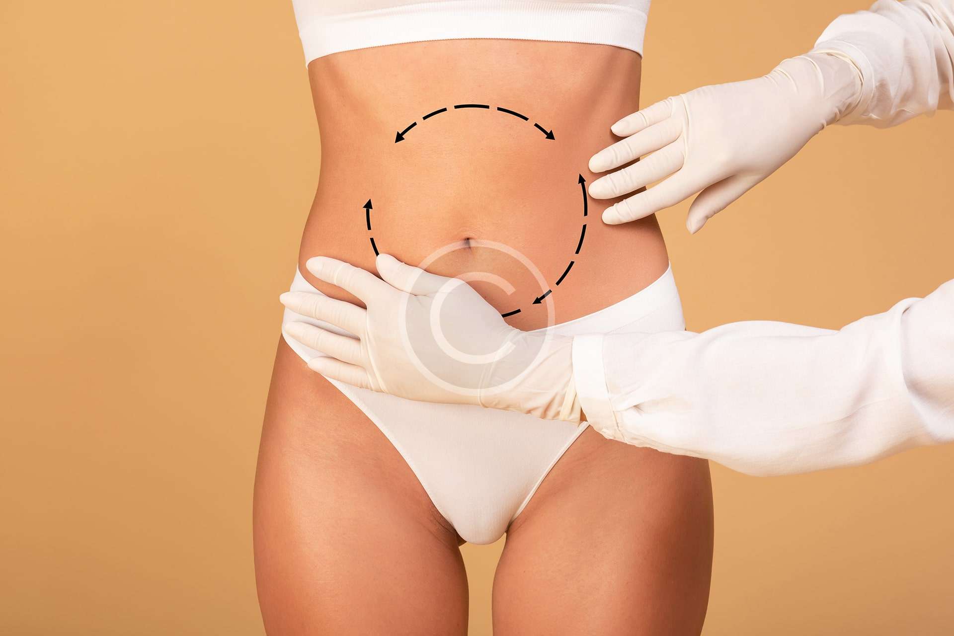 Abdominoplastie