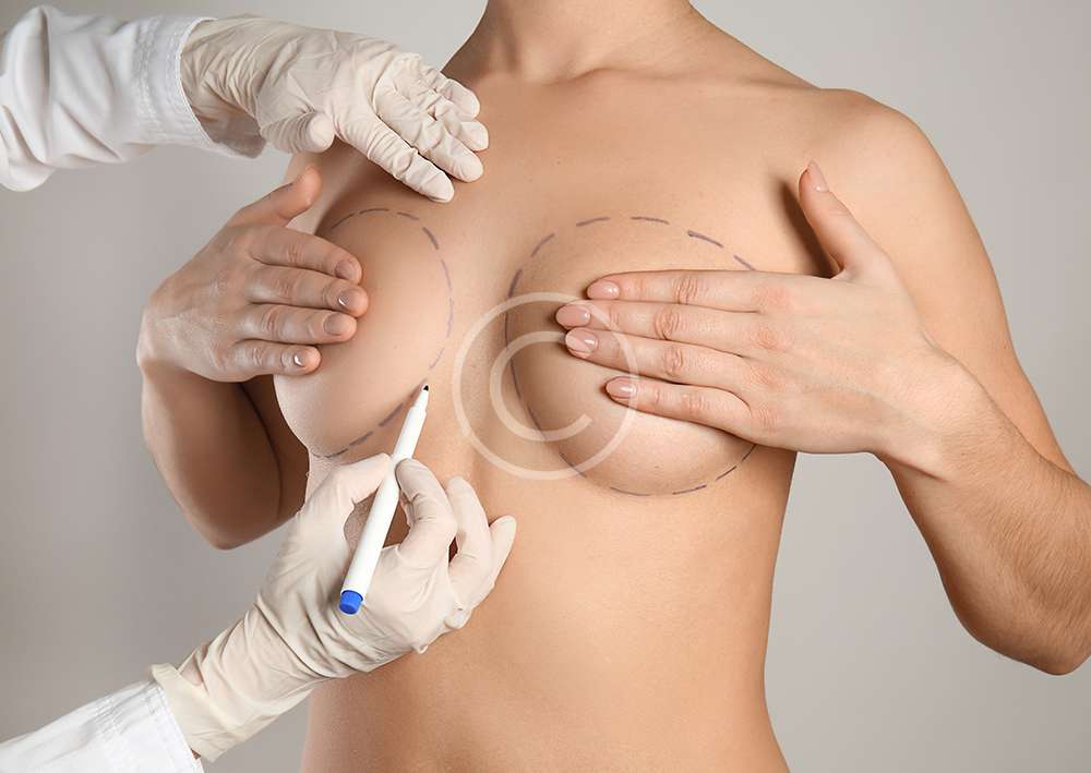 Lifting des seins