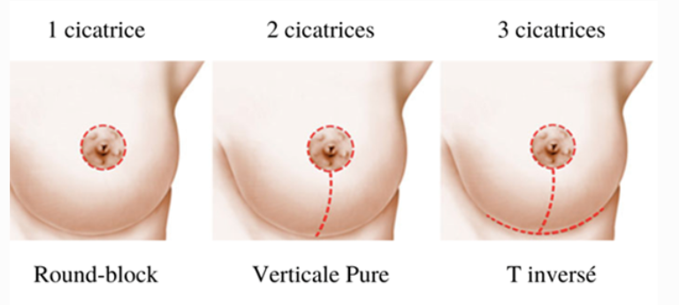 Techniques de lifting mammaire 