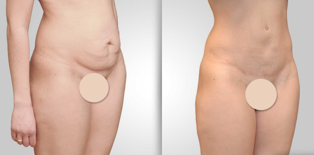 abdominoplastie avant et après vue de côté