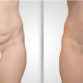 7 choses essentielles à savoir sur l’abdominoplastie (Plastie abdominale)