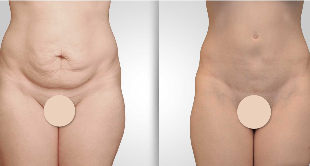 abdominoplastie avant et après