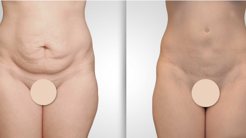 abdominoplastie avant et après
