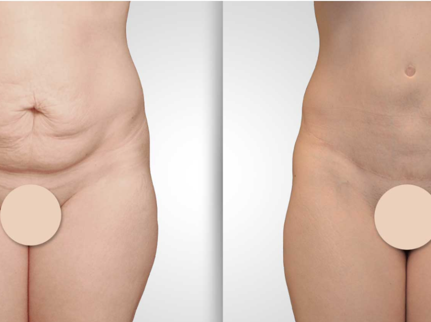 abdominoplastie avant et après