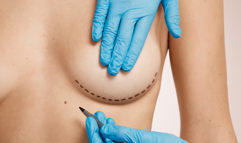 augmentation mammaire par prothèses