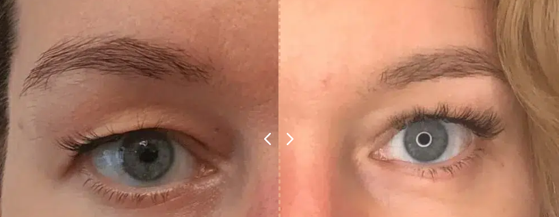 blépharoplastie avant et après