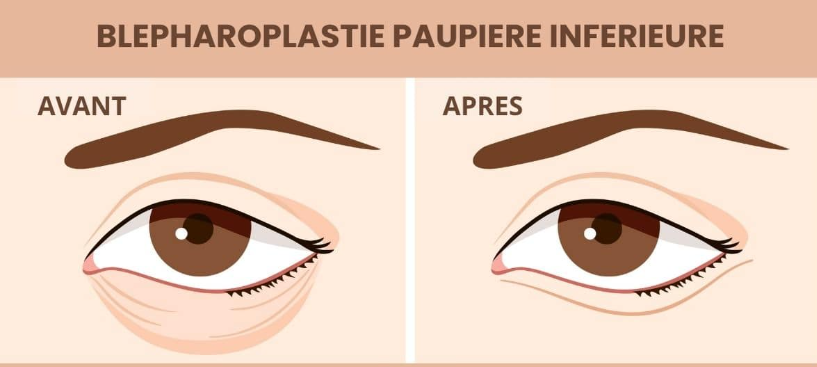 blépharoplastie inférieure