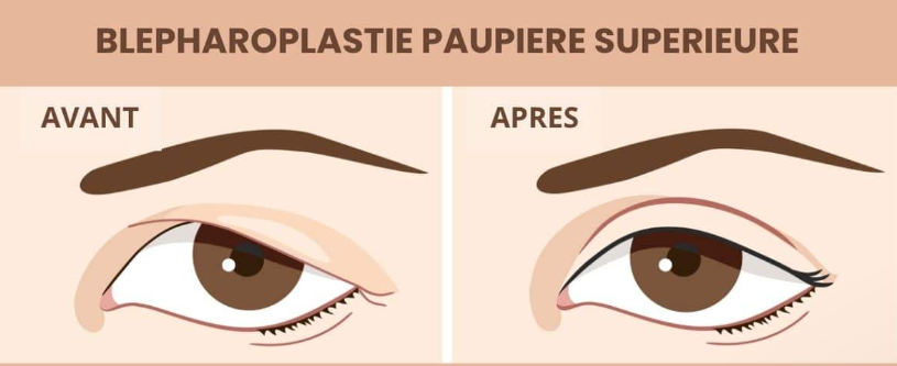 blépharoplastie supérieure